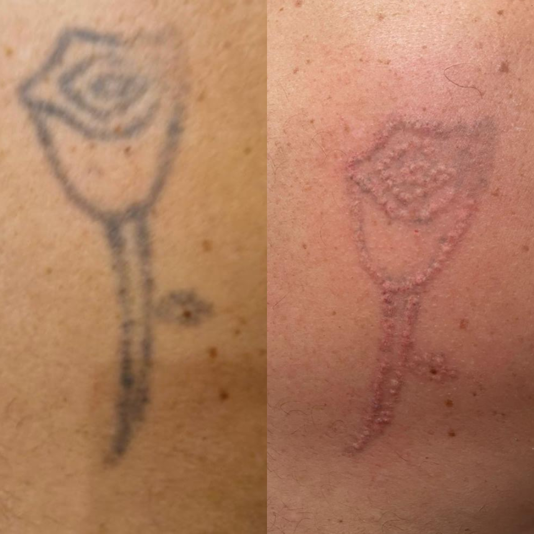 Remoção de Tatuagem — Antes e Depois